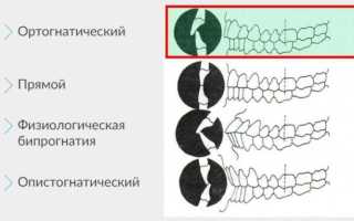 Определение правильного и неправильного прикуса: фото идеального, физиологического и патологического расположения зубов