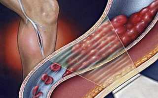 Первые признаки тромбоза артерий, вен, сосудов, лечение и прогноз выживаемости