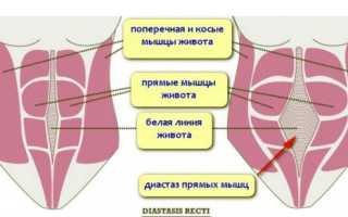 Грыжа белой линии живота