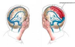 Как улучшить отток крови из головного мозга