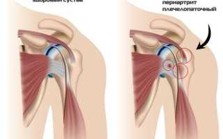Плечелопаточный периартрит