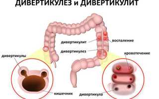 Симптомы и лечение дивертикулита кишечника