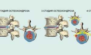 Голова кругом: как бороться с остеохондрозом шейного отдела