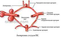 Виллизиев круг разомкнут: что это такое и насколько опасна такая патология