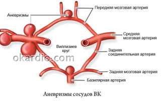 Виллизиев круг разомкнут: что это такое и насколько опасна такая патология