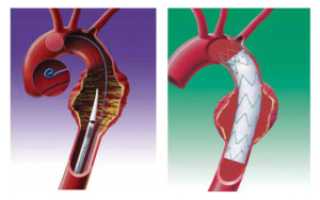 Аневризмы грудной аорты